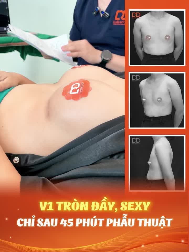 ĐỪNG ĐI NÂNG V1 - VÌ NÂNG XONG SẼ BỊ "VUI" QUÁ!