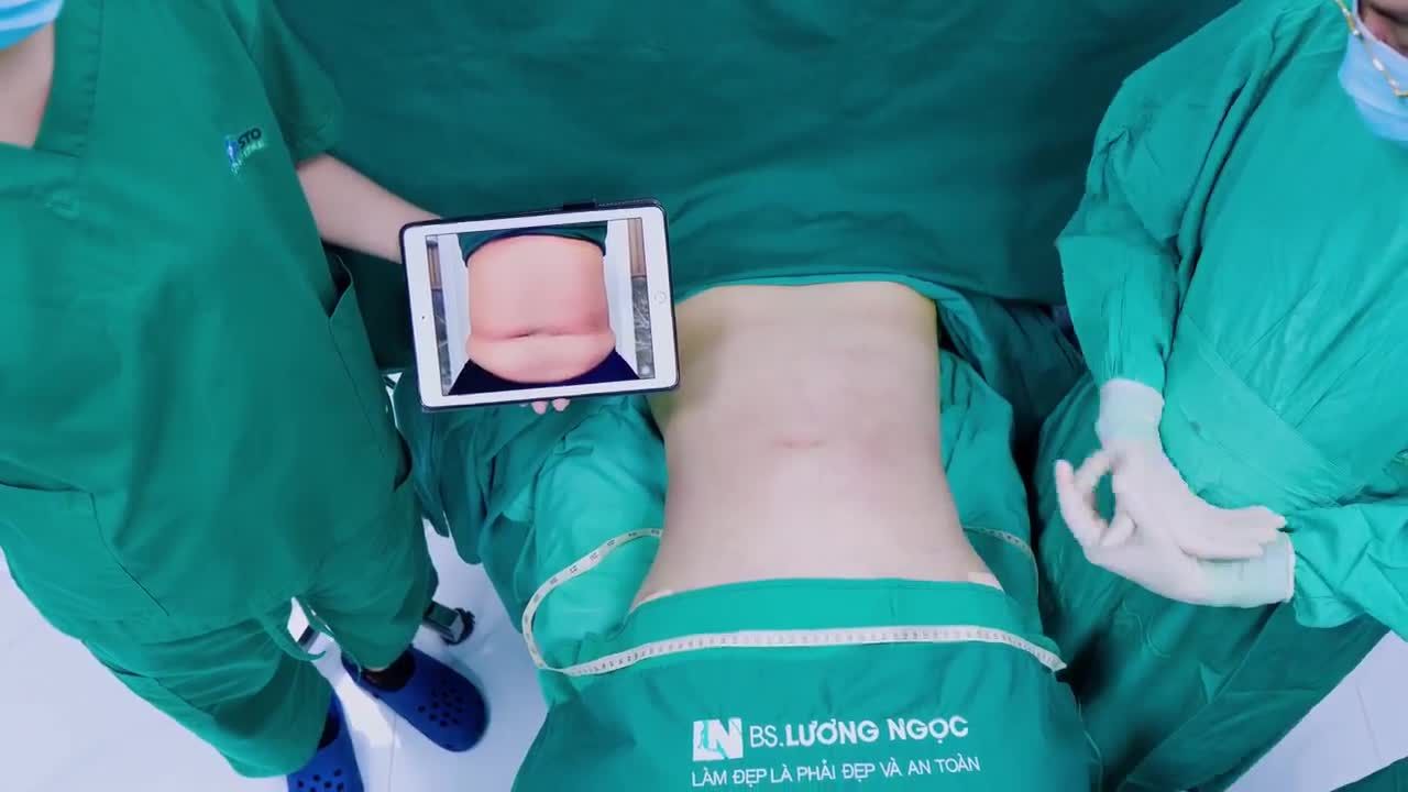 Đã thử nhiều phương pháp để giảm mỡ bụng nhưng không hiệu quả, bạn khách đã lựa chọn giải pháp cuối cùng là “hút mỡ siết eo” tại Ekip Bác sĩ Lương Ngọc vì ở đây KHÔNG CẦN phải căng cắt da như những nơi khác.