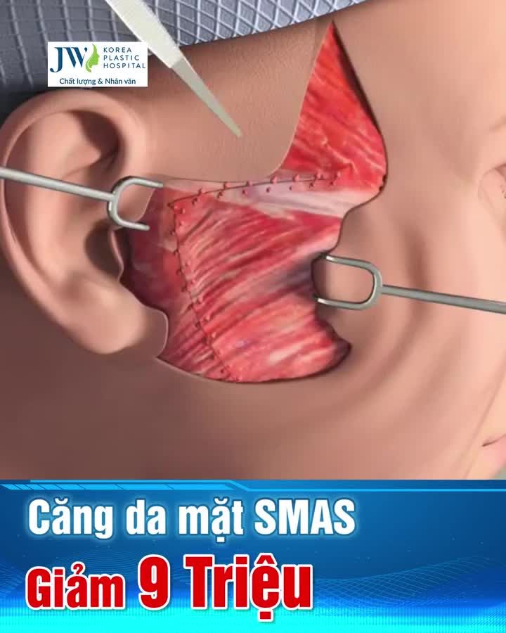 CĂNG DA MẶT SMAS: BÍ THUẬT HỒI XUÂN ĐƯỢC U50-U70 YÊU THÍCH NHẤT JW