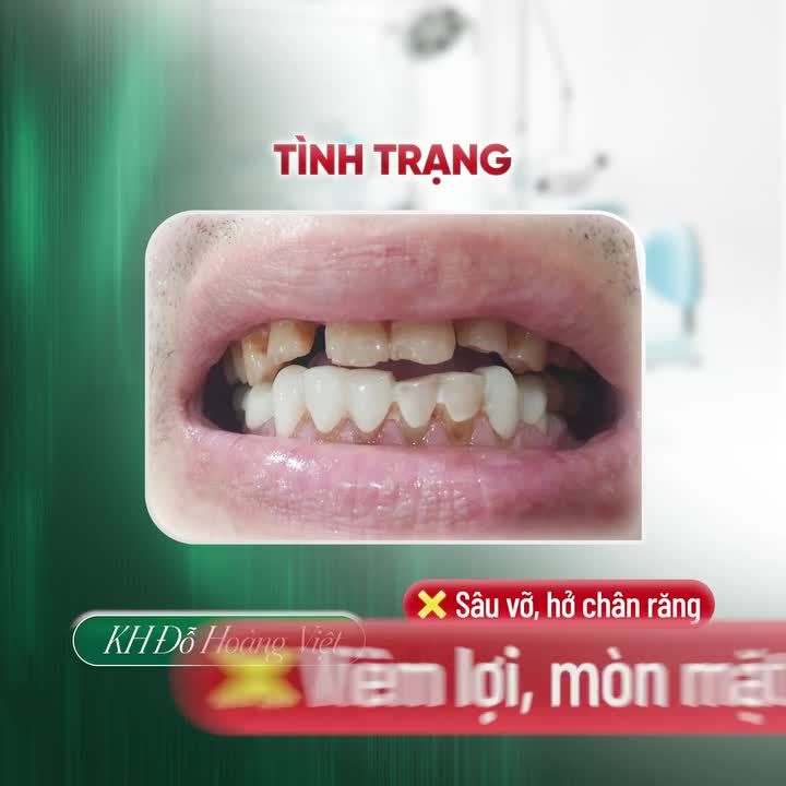 HÀNH TRÌNH LẤY LẠI NỤ CƯỜI HOÀN HẢO TẠI NHA KHOA GIA ĐÌNH