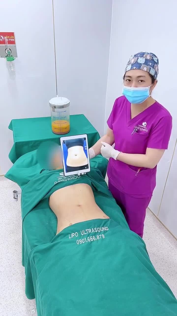 LẤY LẠI VÒNG EO THON GỌN, SĂN CHẮC CHO CHỊ KHÁCH HÀNG VIỆT KIỀU MỸ NHỜ LIPO ULTRASOUND