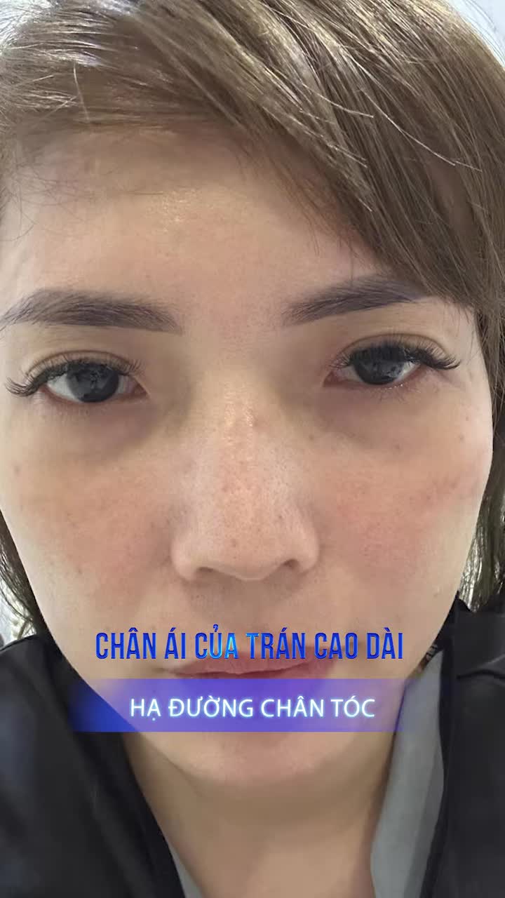 Hành trình xóa bỏ trán cao tìm được chân ái đời mình