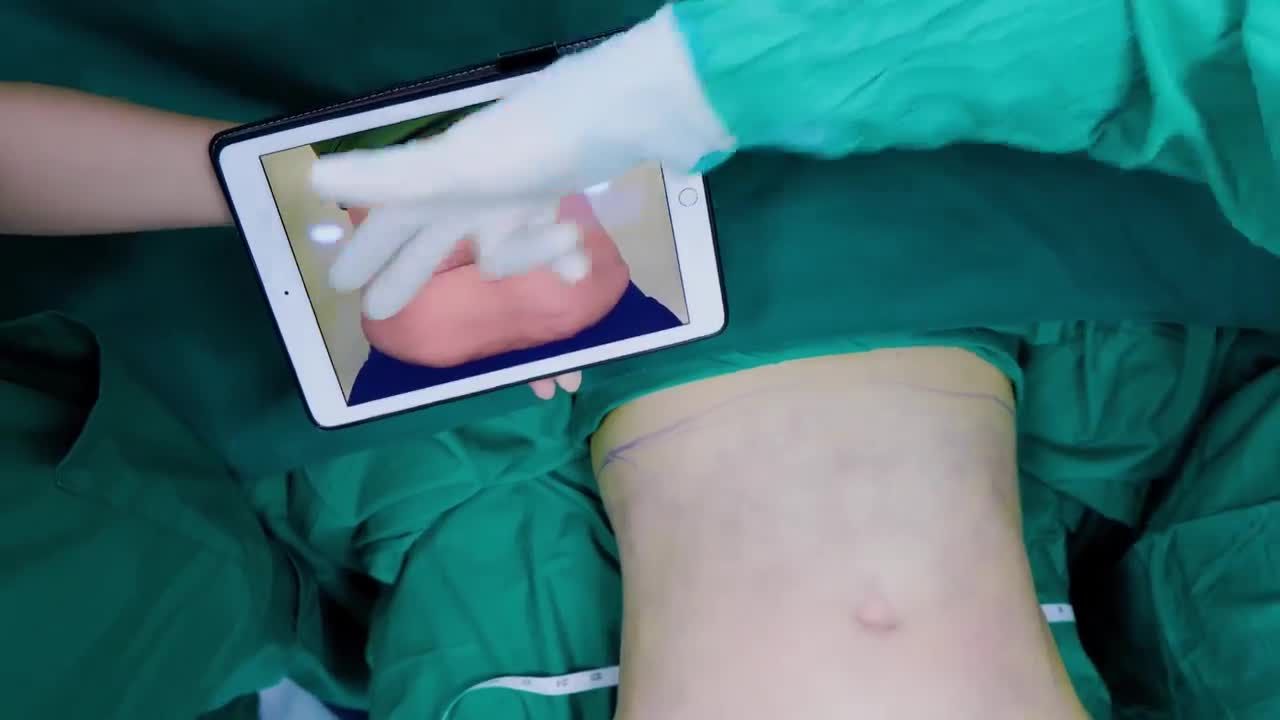 Tình trạng chị khách trước khi thực hiện: bụng dư da, dư mỡ chảy xệ và có độ chùng nhão lớn.
