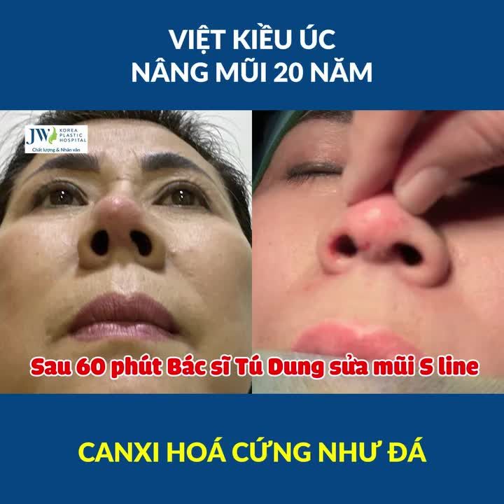 Bác sĩ Tú Dung NẠO KHẨN chiếc mũi bị CANXI HÓA 20 NĂM của Việt kiều Úc CỨNG HƠN ĐÁ