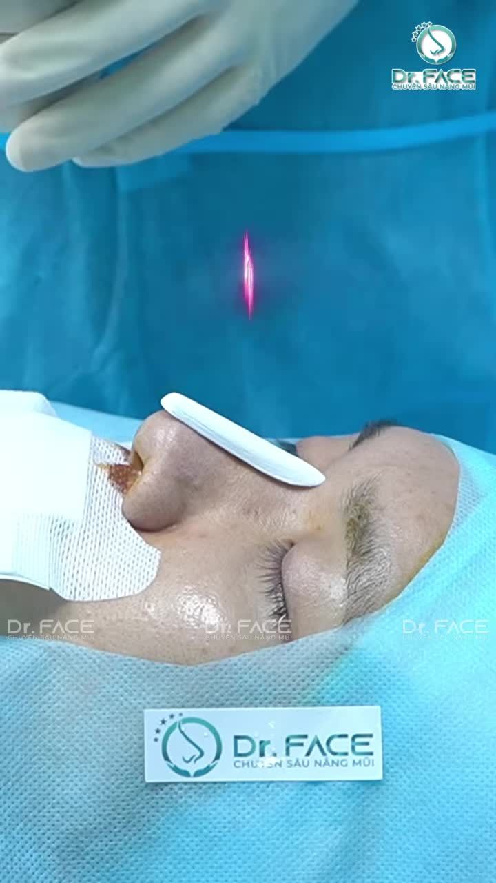 MŨI NAM nâng CAO NHIỀU cho “MEN” được không bs?