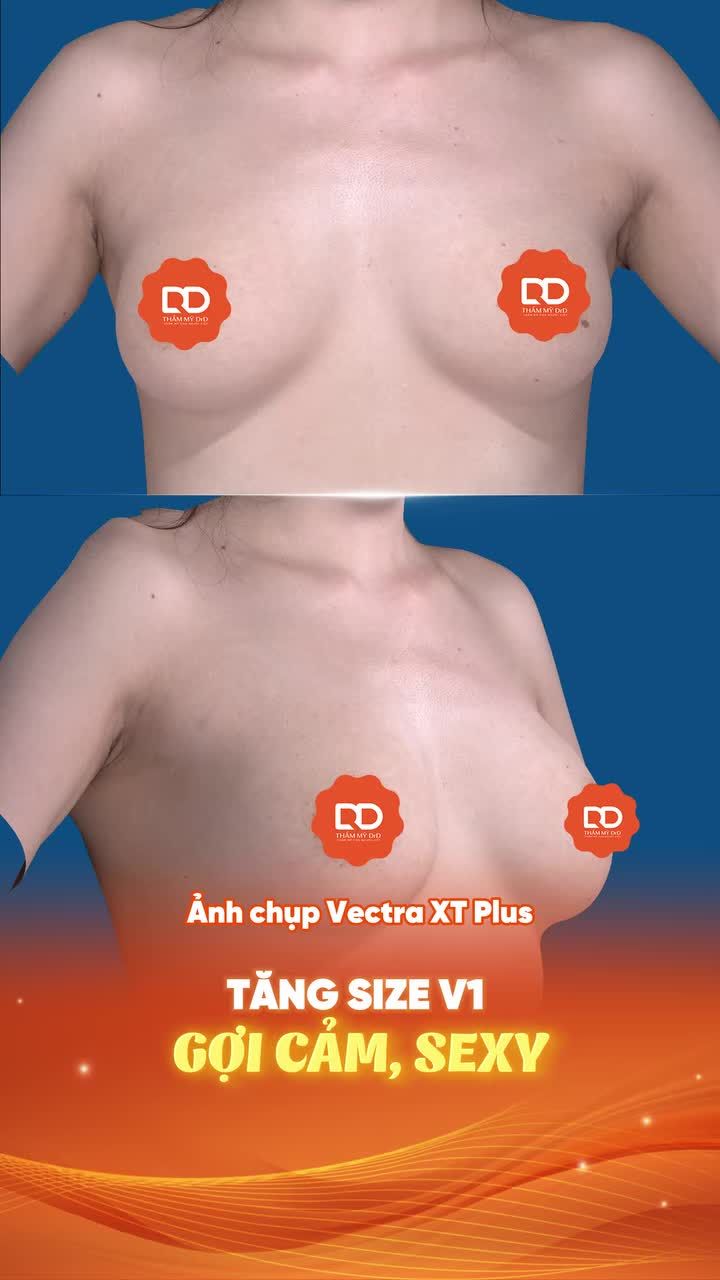 Ngực phẳng lì "nam tính" - Hóa tròn căng, sexy - Chỉ sau 45 phút phẫu thuật