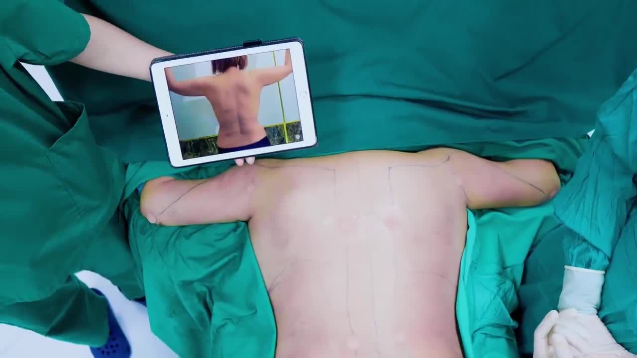 Đã từng hút mỡ thất bại tại Đức. Chị khách quyết định lặn lội về Việt Nam vì được người quen giới thiệu Ekip Bác sĩ Lương Ngọc.