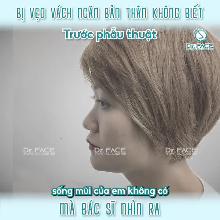 BỊ VẸO VÁCH NGĂN bản thân không biết…mà BÁC SĨ NHÌN RA
