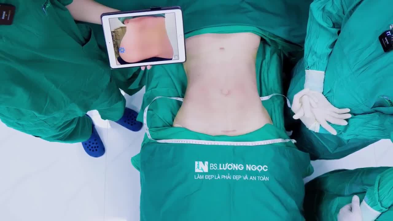 Sau lần sinh mổ đầy đau đớn, chị khách phải chịu vết sẹo lồi dài ngoằng trên bụng và để lại nỗi ám ảnh về việc phẫu thuật.