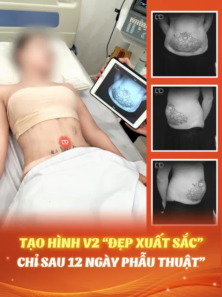 TẠO HÌNH V2 ĐẸP MÊ CHỈ SAU 12 NGÀY PHẪU THUẬT