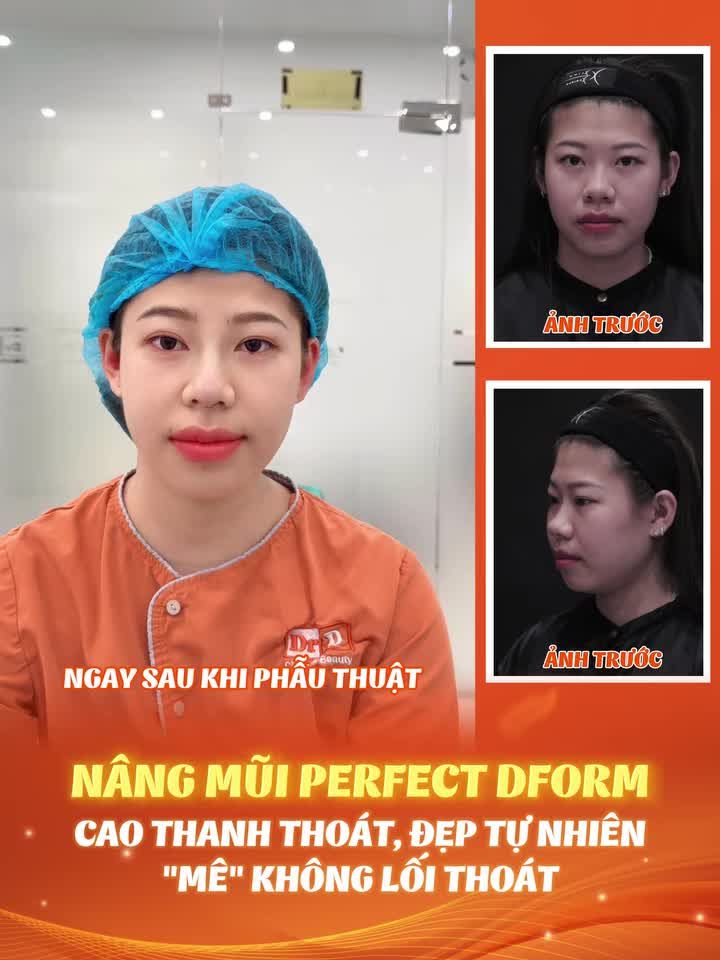 NÂNG MŨI PERFECT DFORM - CAO THANH THOÁT - ĐẸP TỰ NHIÊN - "MÊ" KHÔNG LỐI THOÁT