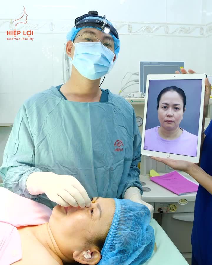Xử lý ca mũi "bị lộ sóng, da mỏng" sau 16 năm nâng mũi cho chị KH đến từ Singapore