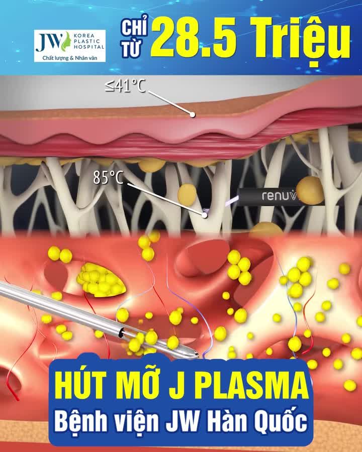 CÔNG NGHỆ HÚT MỠ J PLASMA KHÔNG PHẪU THUẬT TÁI TẠO VÓC DÁNG