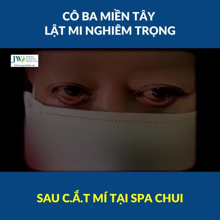 Cô ba miền Tây U50 LẬT MI ĐỎ TƯƠI  sau cắt mí ở Spa loi choi