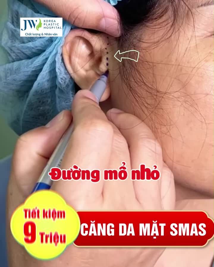 CĂNG DA MẶT SMAS – BÍ THUẬT CẢI LÃO HỒI XUÂN