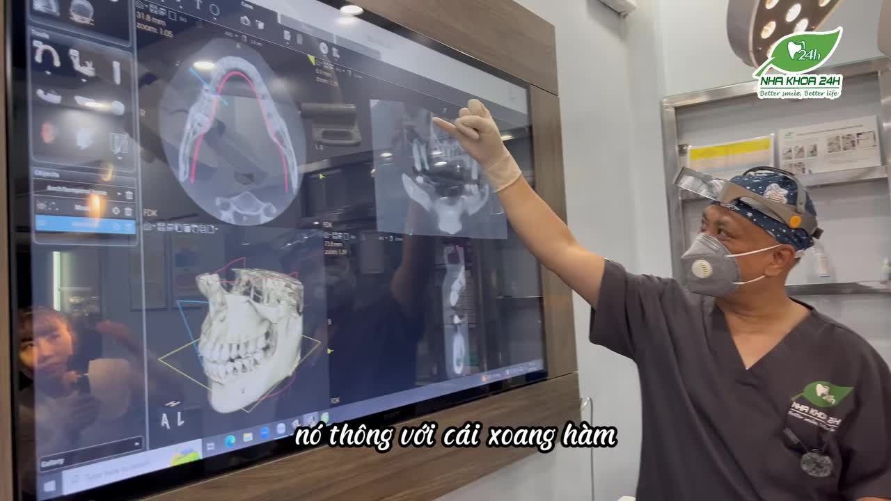 hẫu Thuật Ghép Xương và Ghép Mô Mềm Bịt Lỗ Thông Xoang Sau Nhổ Răng và Cắt Nang