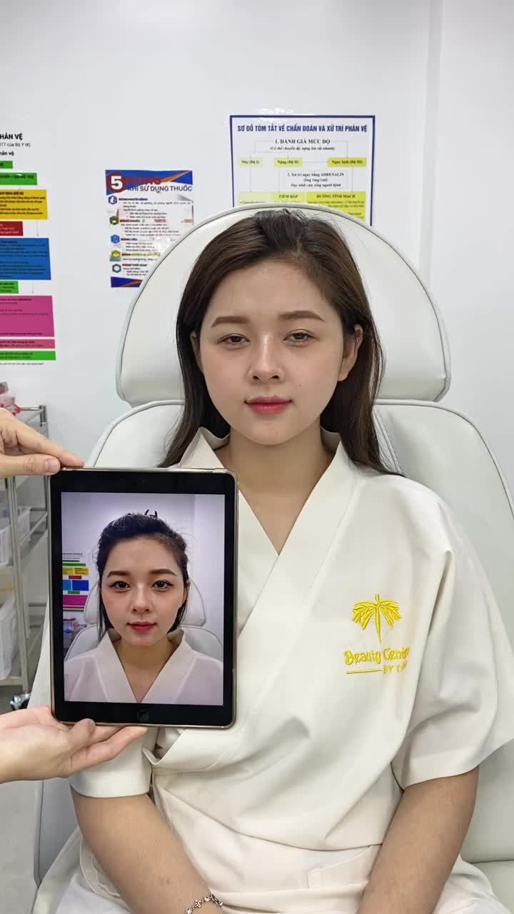 FILLER MÁ, CẰM ĐÃ GIÚP DIỆU LINH THAY ĐỔI NHƯ THẾ NÀO?