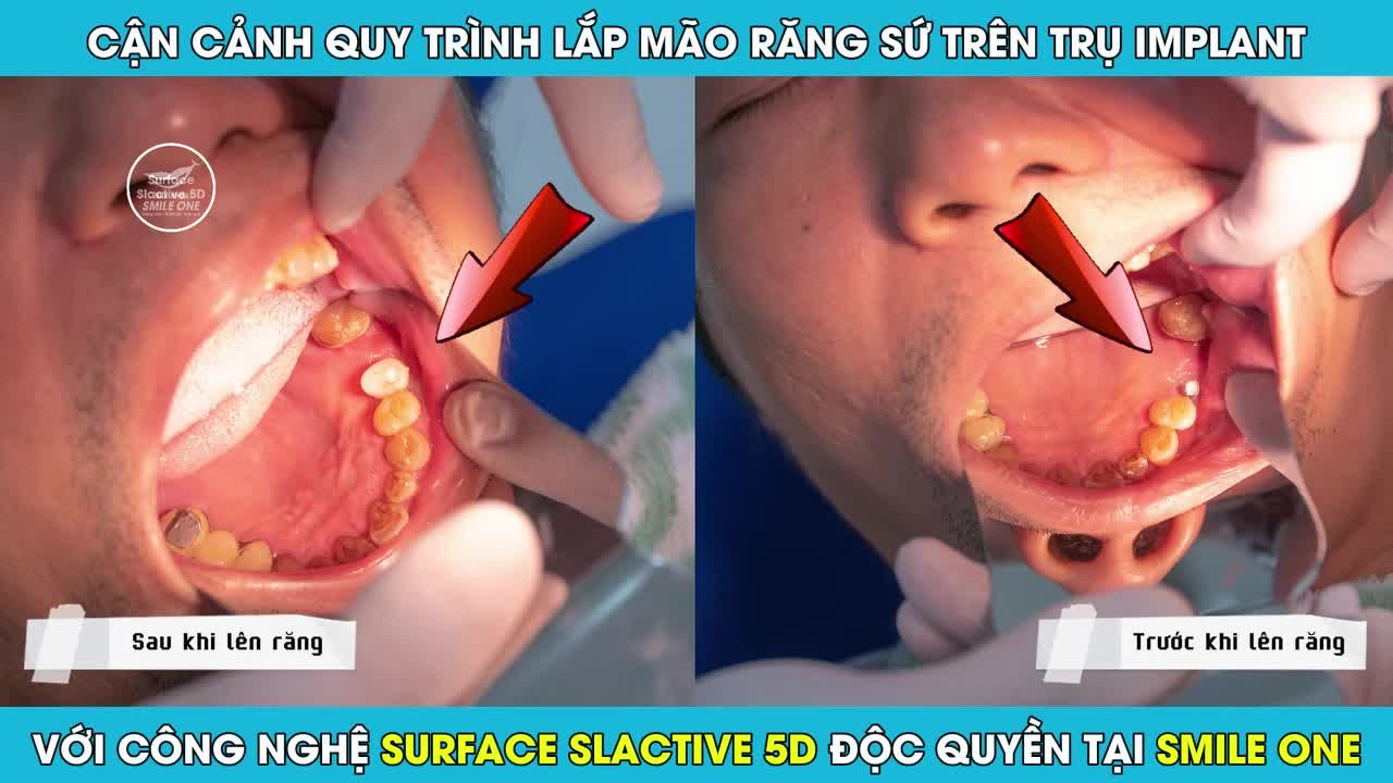 Trồng răng Implant là phương pháp cấy ghép trụ Implant vào xương hàm để thay thế chân răng cũ đã mất.