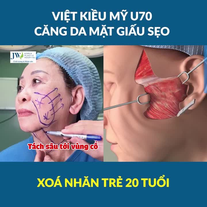 Bác sĩ Tú Dung căng da mặt GIẤU SẸO, trẻ hoá mắt XOÁ NẾP NHĂN cho Việt kiều Mỹ U70 TRẺ 20 TUỔI