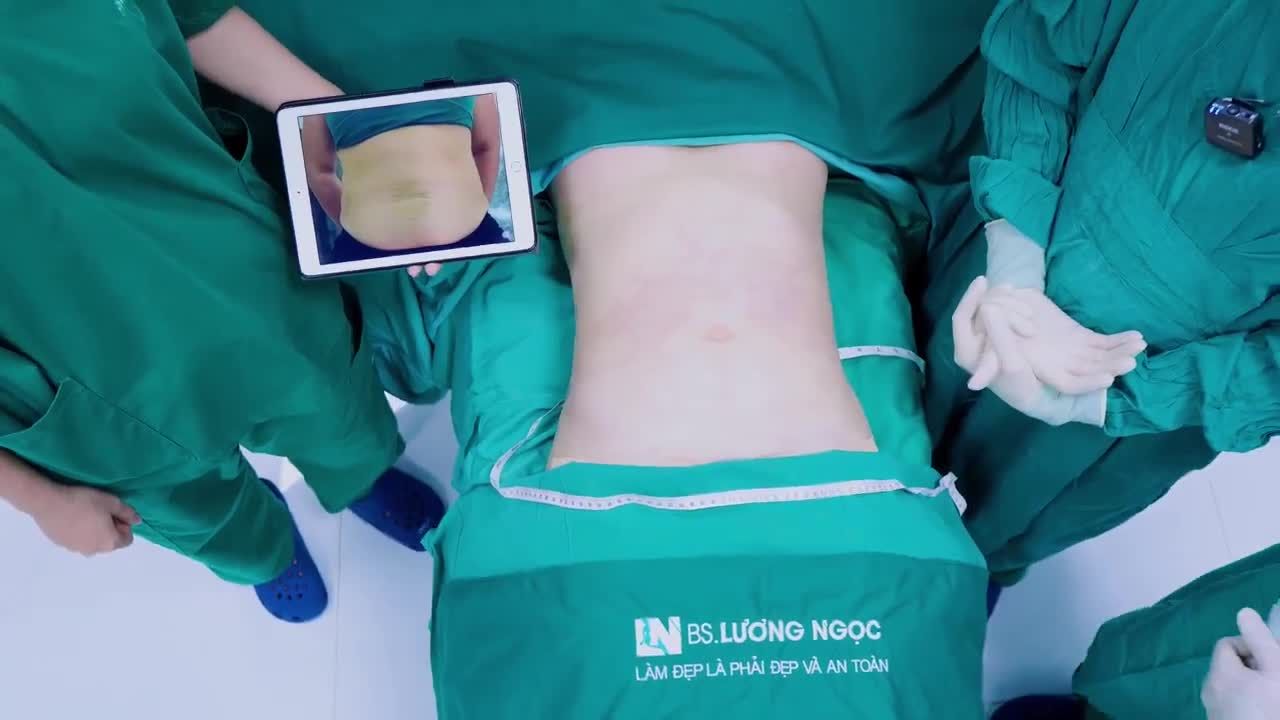 Sau khi sinh mổ, bụng bạn khách có để lại một vết sẹo dài và lồi dưới rốn.