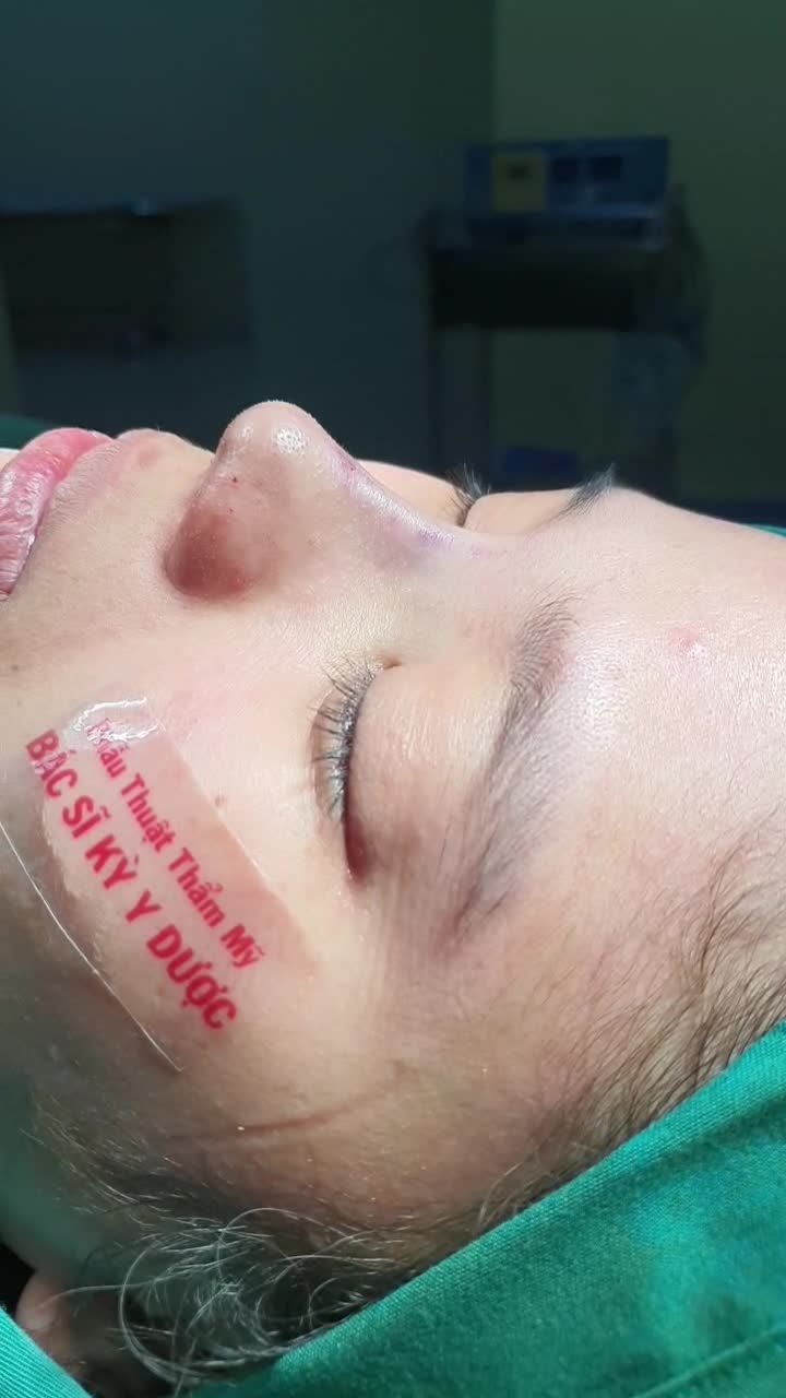 Tại sao nên chọn nâng mũi ALINE tại Bác sĩ Kỳ ở Nha Trang?