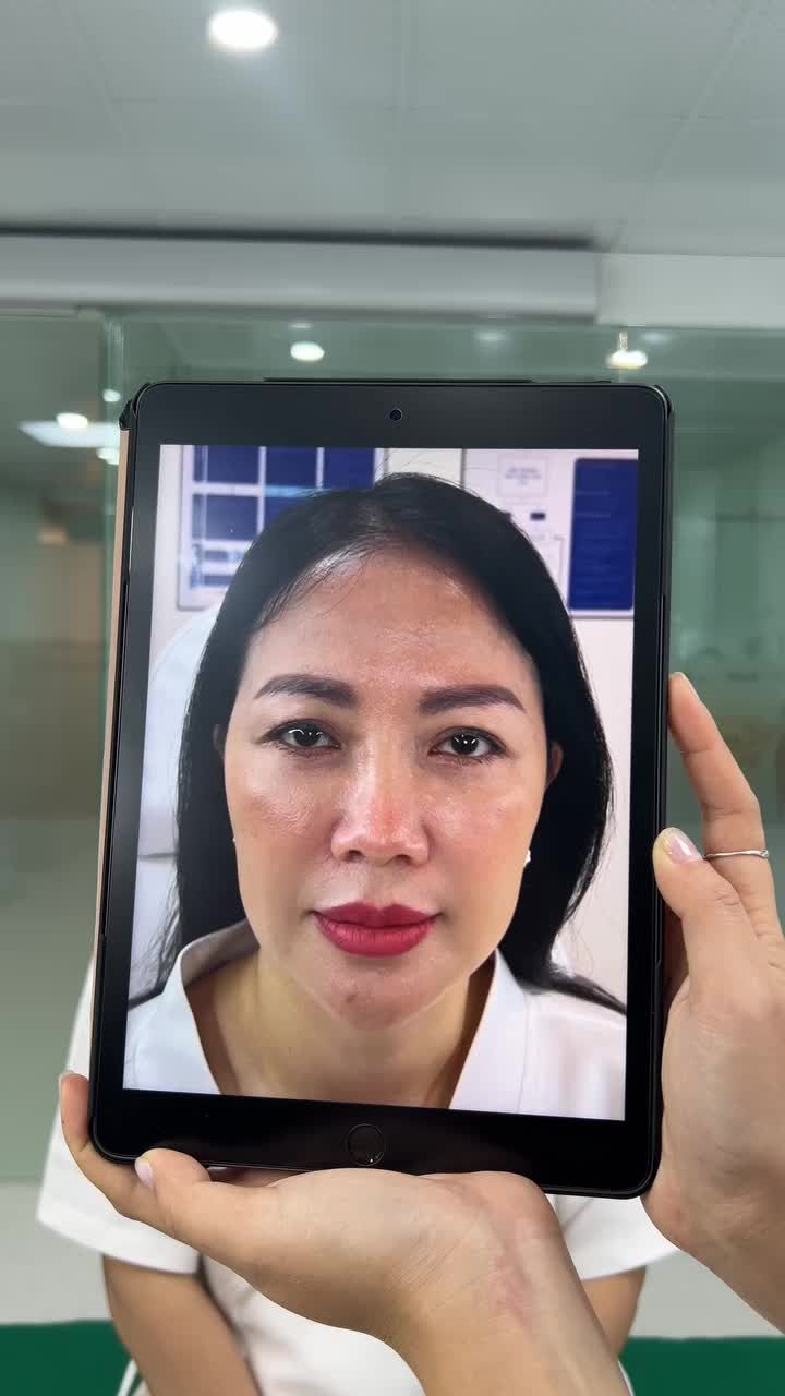 Lần đầu đi làm filler, chị khá lo, nhưng khi đến thì bác sĩ tư vấn rất nhiệt tình và do bác mát tay nữa nên lúc vừa làm xong, nhìn gương chị rất ưng, cũng may quá là không sưng bầm gì vì mai chị vẫn phải đi làm.