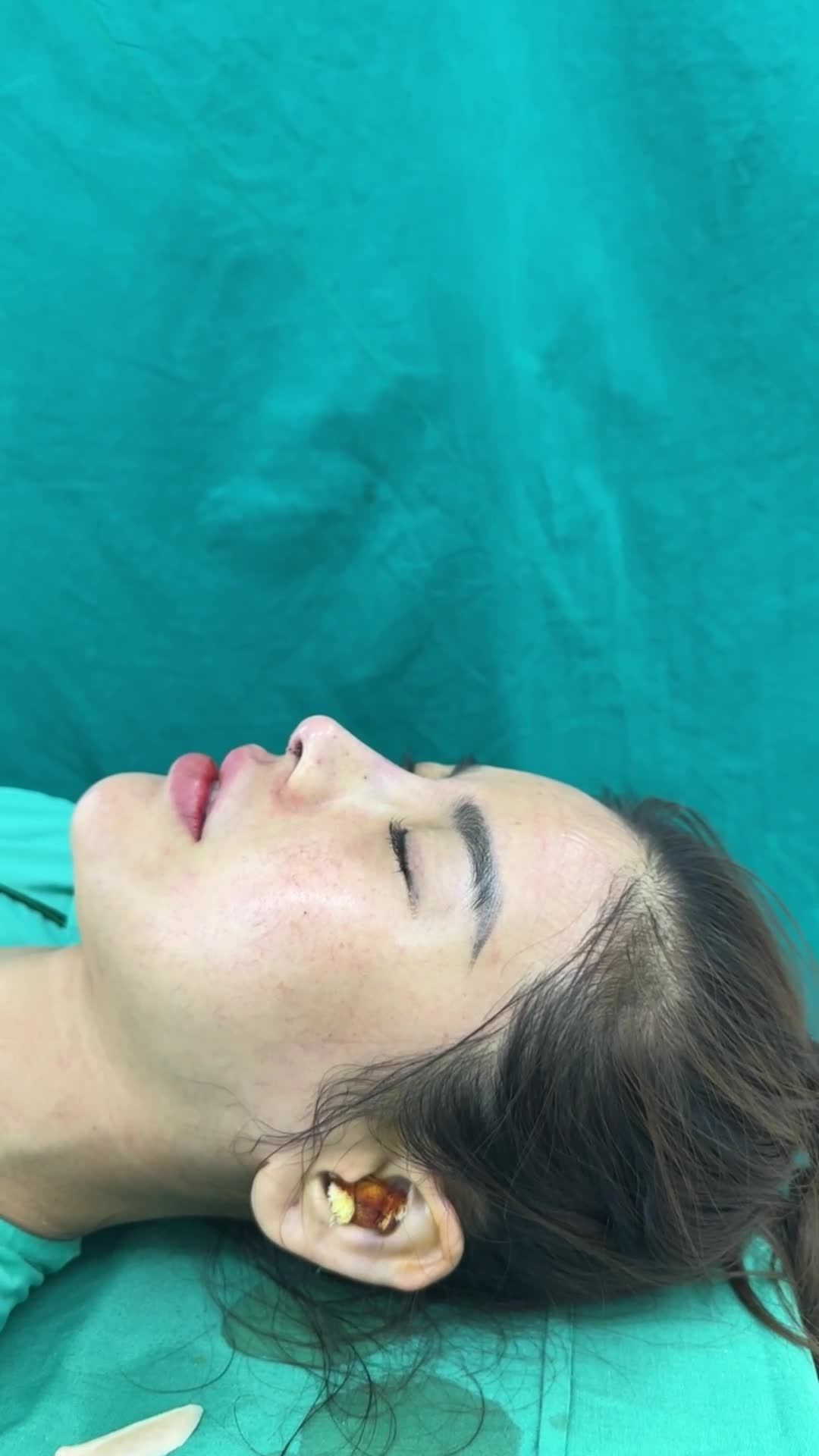 Ca mũi cấu trúc sửa lại cuối ngày tại Tuấn Linh!!