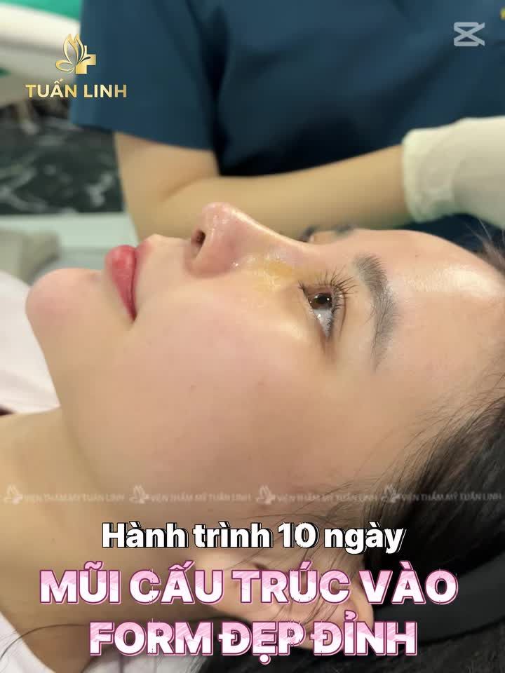 Mũi cấu trúc và hành trình 10 ngày vào form ''đẹp đỉnh''!!