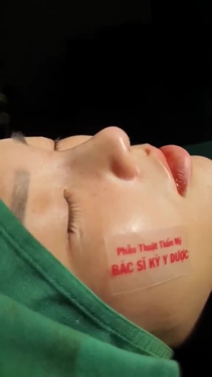 CHỌN NÂNG MŨI ALINE - CÓ NGAY DÁNG MŨI ĐẸP