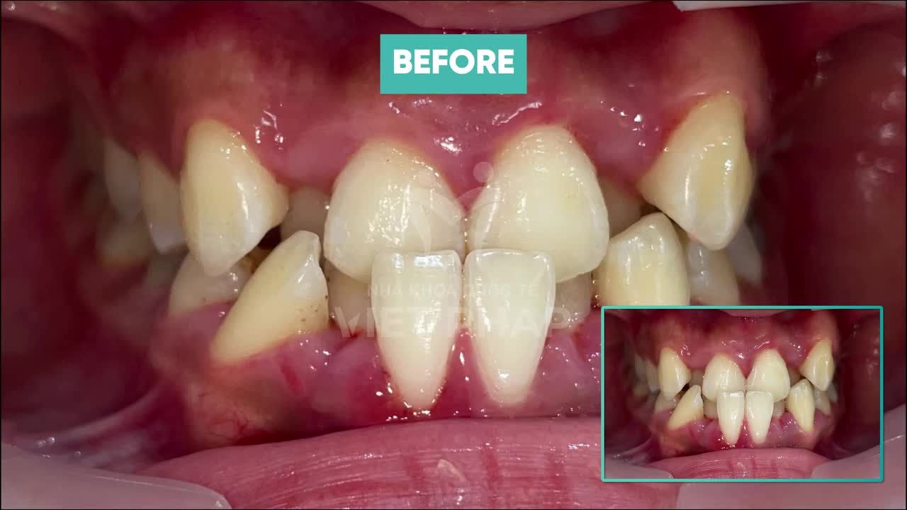 QUÁ TRÌNH DỊCH CHUYỂN RĂNG CHEN CHÚC NẶNG - 24 THÁNG THAY ĐỔI NGOẠN MỤC