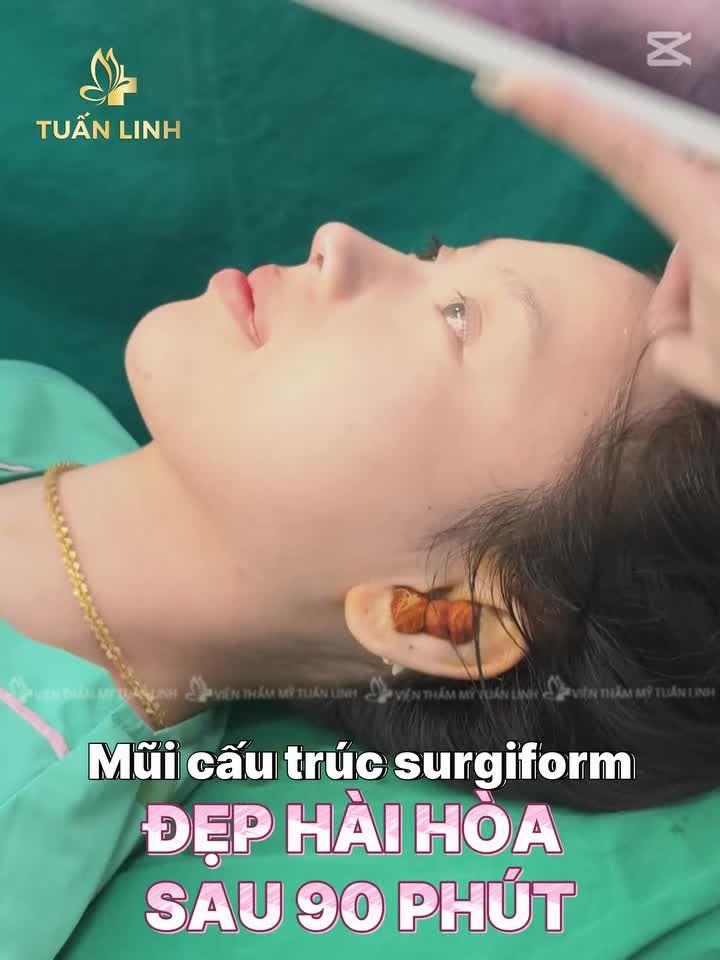 Muốn mũi đẹp tự nhiên mà vẫn sắc nét và lâu bền => Chọn nâng mũi cấu trúc Surgiform nha - Phương pháp nâng mũi tối ưu được các bác sĩ/ chuyên gia thẩm mỹ khuyên dùng!!