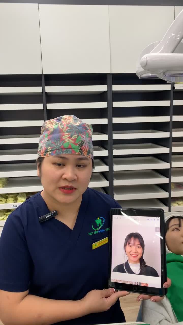 Cận cảnh ca gắn mắc cài điều trị tình trạng răng khấp khểnh, khớp cắn sâu và cung hàm hẹp cho bạn Hà Giang.
