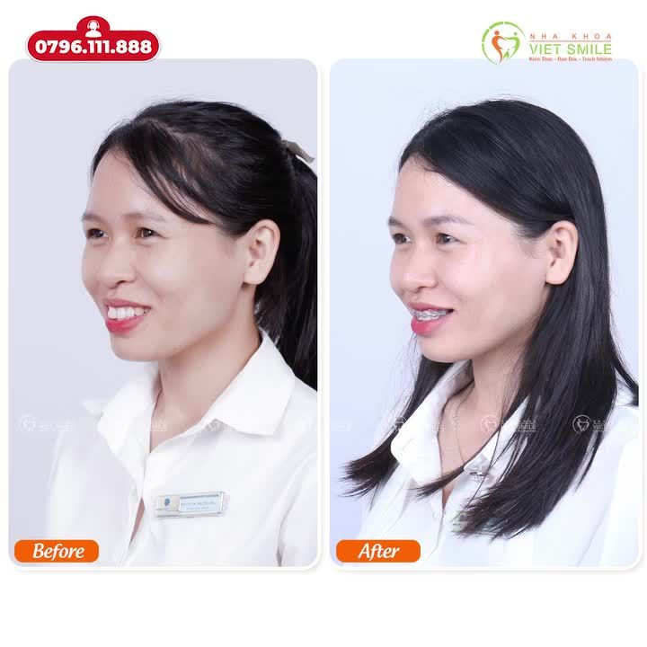 NIỀNG RĂNG VỚI BÁC SĨ UY TÍN - ĐÓN NHẬN KẾT QUẢ TUYỆT VỜI