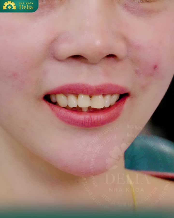 XÓA SỔ RĂNG Ố VÀNG, KHÔNG ĐỀU ĐÓN TẾT RẠNG NGỜI