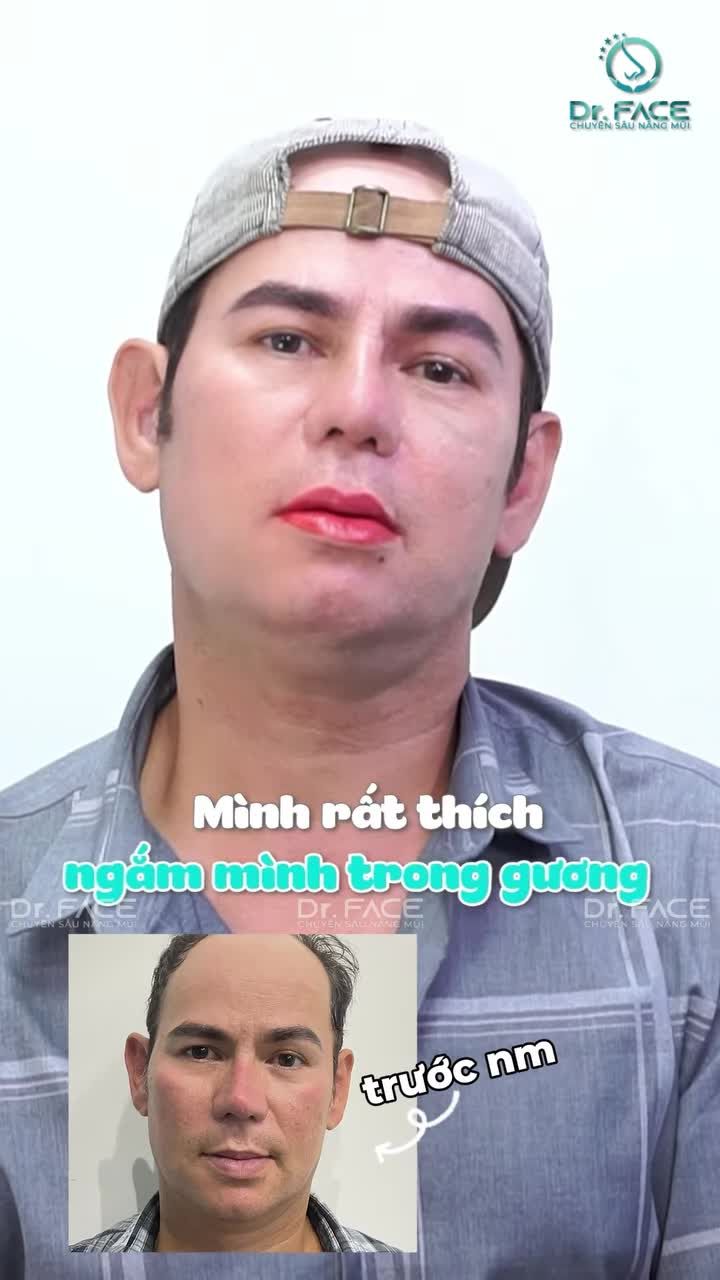 Điều NGƯỜI TA HAY LÀM sau nâng mũi là gì nhỉ?