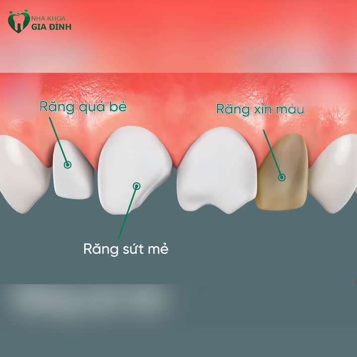 KHÁM PHÁ QUÁ TRÌNH DÁN RĂNG SỨ VENEER – TỪ MẤT TỰ TIN ĐẾN NỤ CƯỜI HOÀN HẢO