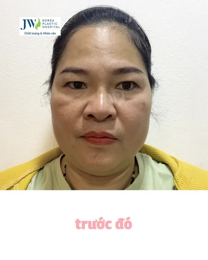 VIỆT KIỀU BỐI RỐI TRẺ 20 TUỔI SAU COMBO CẮT MẮT + NÂNG MŨI ĐÓN TẾT