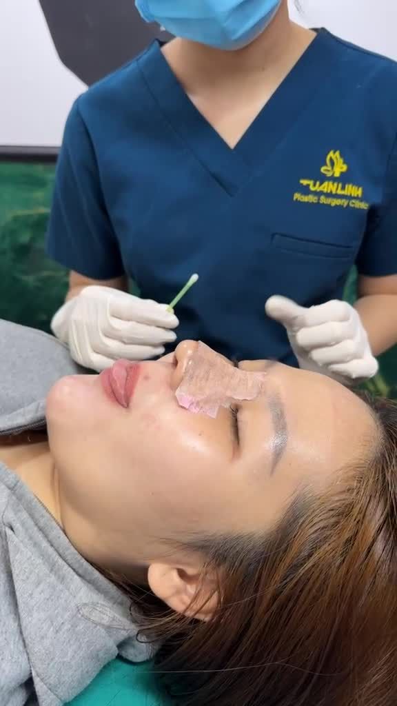 Case mũi cấu trúc surgiform được 10 ngày!!!
