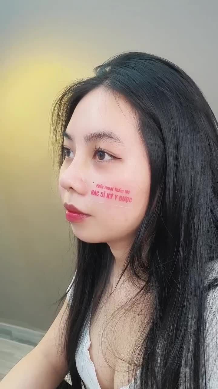 NÂNG MŨI ALINE Mũi xinh lung linh - Đón Tết vẹn toàn