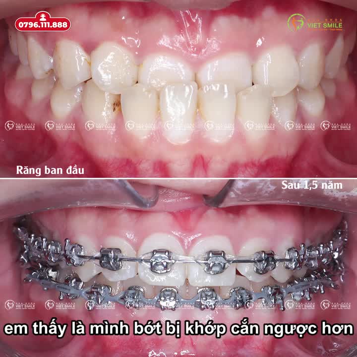 BIẾN ĐỔI DIỆU KỲ: TỪ MẶT MÓM ĐẾN NỤ CƯỜI TỰ TIN