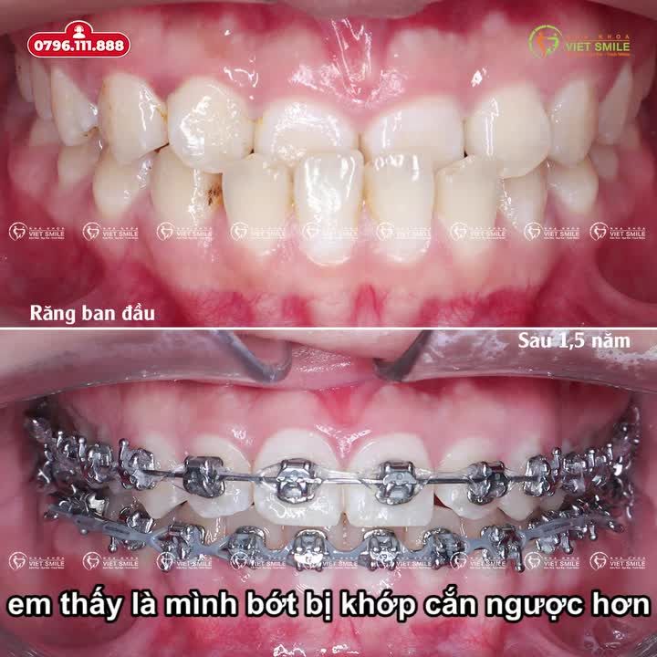 BIẾN ĐỔI DIỆU KỲ: TỪ MẶT MÓM ĐẾN NỤ CƯỜI TỰ TIN