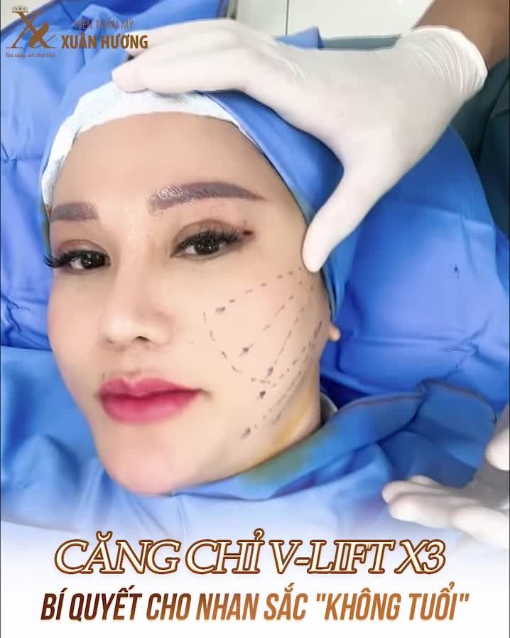 Căng chỉ V-lift X3 - Bí quyết nhan sắc không tuổi của Chủ tịch HĐQT VTM Xuân Hương