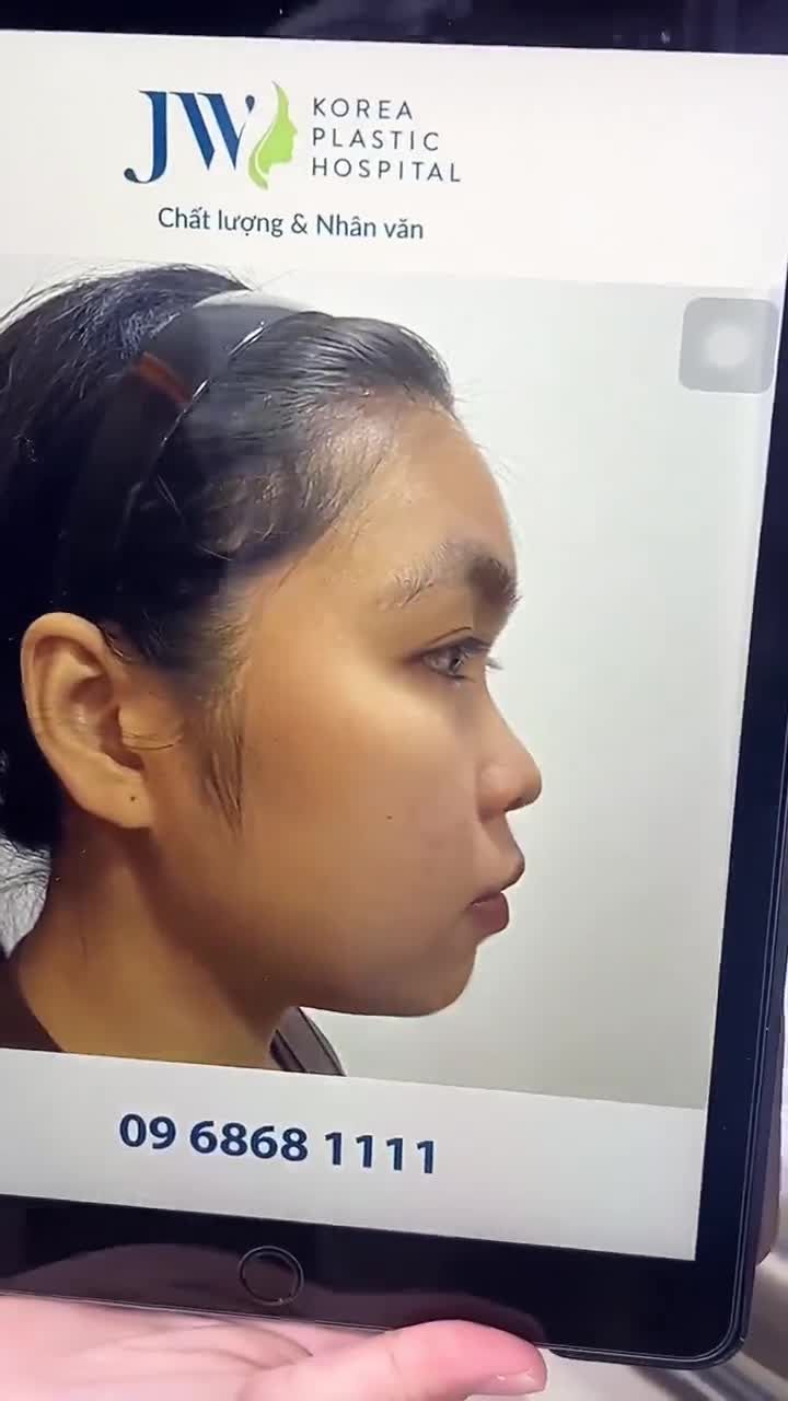 Kết quả NÂNG MŨI S LINE 3D cho nữ sinh GEN Z mũi đẹp TỰ NHIÊN, MỀM MẠI tại Bệnh viện JW