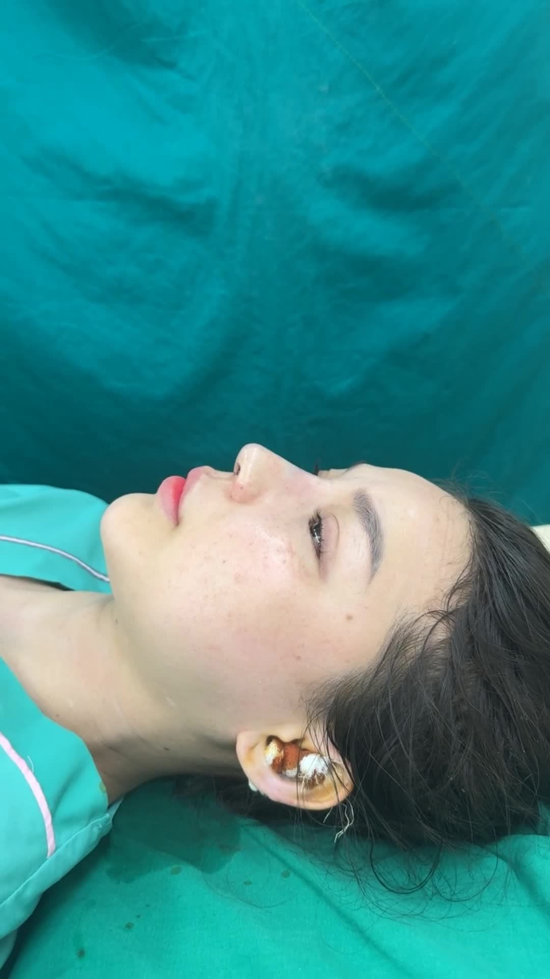 Case mũi nâng cấp cấu trúc cho khách hàng cũ đẹp hài hòa ngay sau phẫu thuật!!