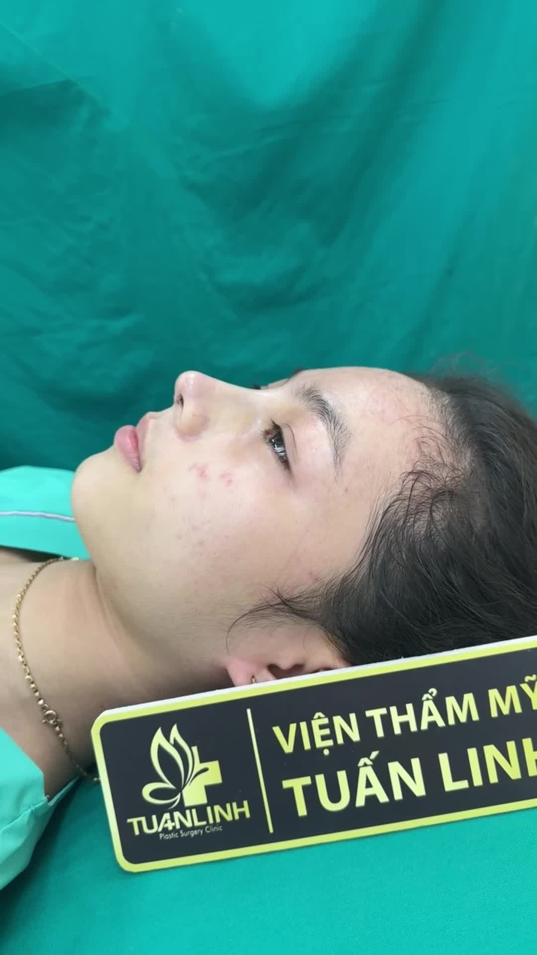 Ca nâng mũi cấu trúc vừa hoàn thành