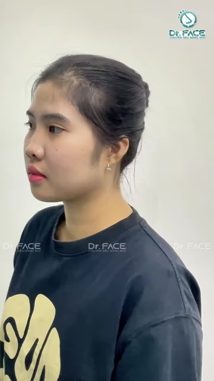 Mũi em GỒ LẠ LẮM, BS sửa được không?
