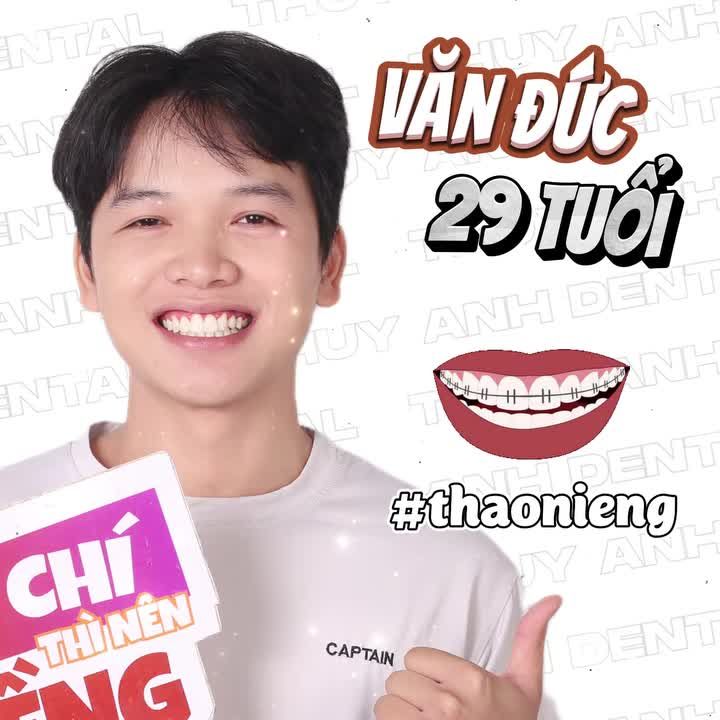 NỤ CƯỜI CHÂN ÁI ĐÃ ĐẾN SAU QUYẾT TÂM NIỀNG RĂNG LẠI LẦN 2