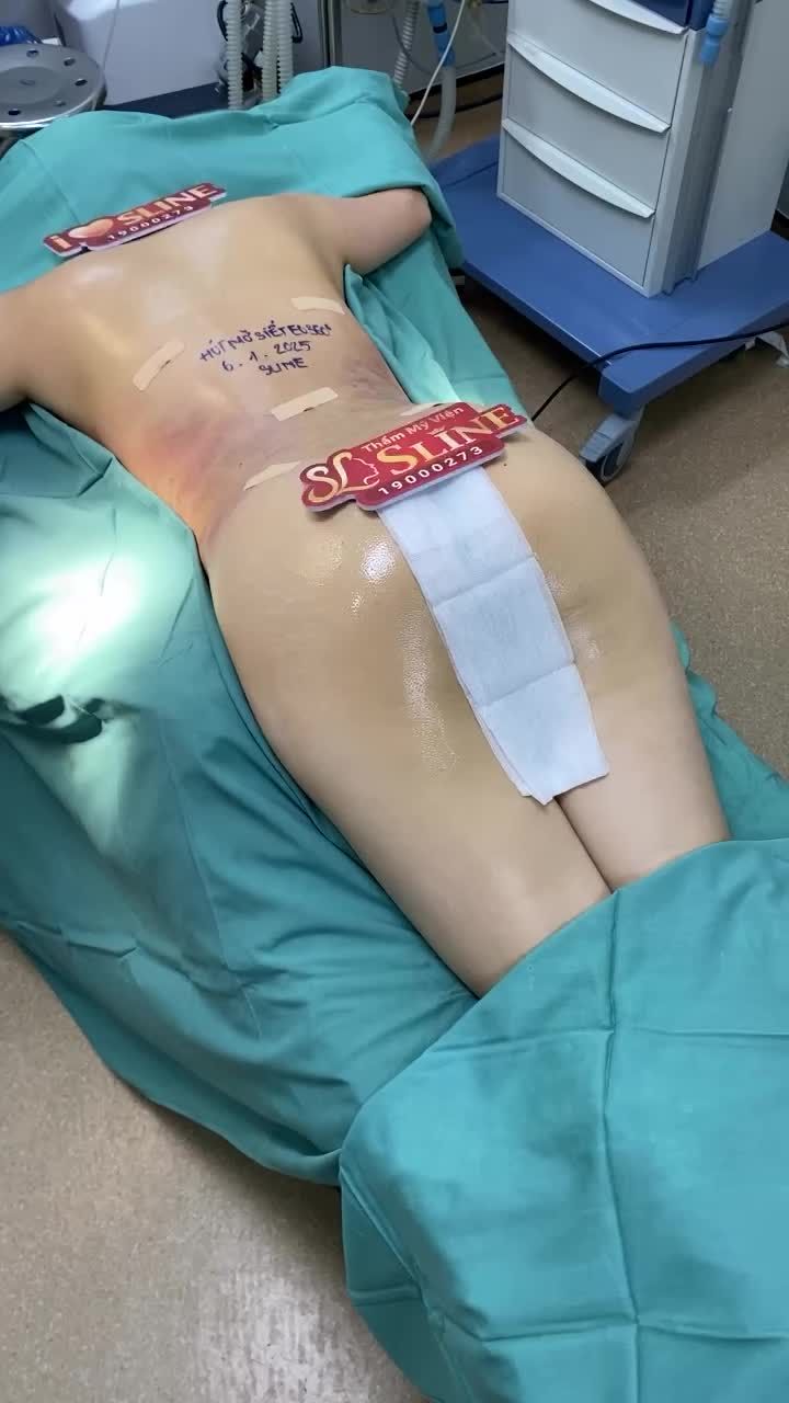 Thay đổi đường cong trên body với dịch vụ Hút mỡ siết eo360 Và đây là những gì khách hàng đã nhận được!