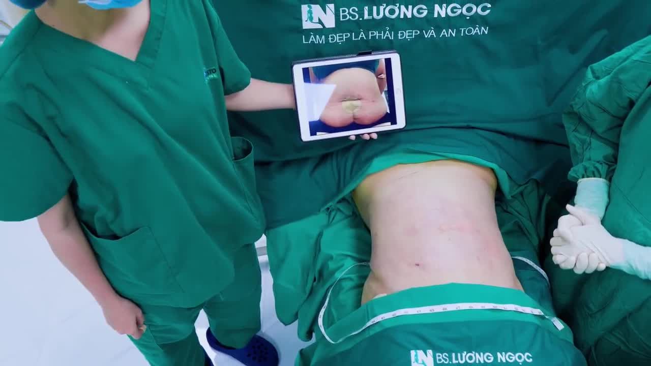 Khách hàng đã trải qua 2 lần sinh mổ, để lại vết sẹo dài ngăn cách ở giữa bụng. Qua thăm khám, Bác sĩ đánh giá đây là vòng bụng nhiều mỡ thừa, da dư và cấu trúc da gãy đổ.