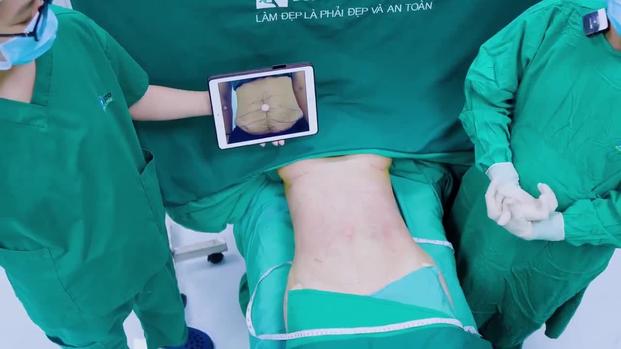 Vòng 2 mỡ thừa, da dư nhăn nheo, cấu trúc da bị đứt gãy liên kết và gần như mất hết độ đàn hồi - Đây là tình trạng của chị khách đến từ Hoa Kỳ.